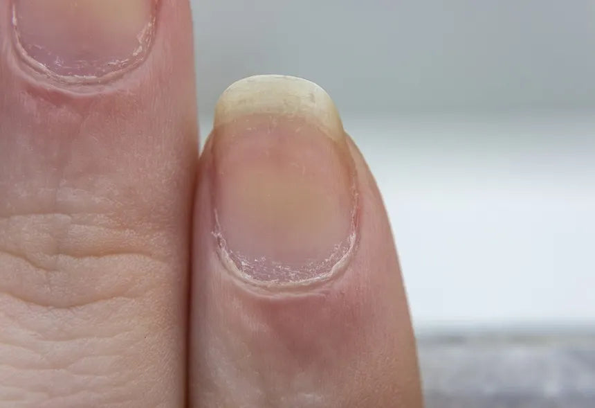 Your fingernails look like THIS when you’re deficient in selenium ...